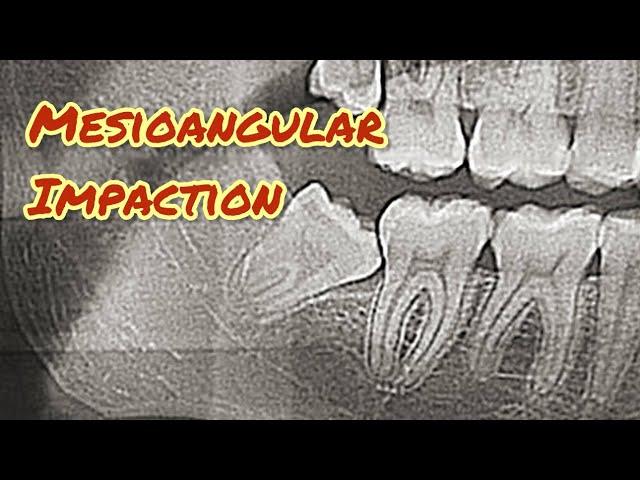 Mesioangular Wisdom Tooth Extraction Video Step-by-Step @drwahan