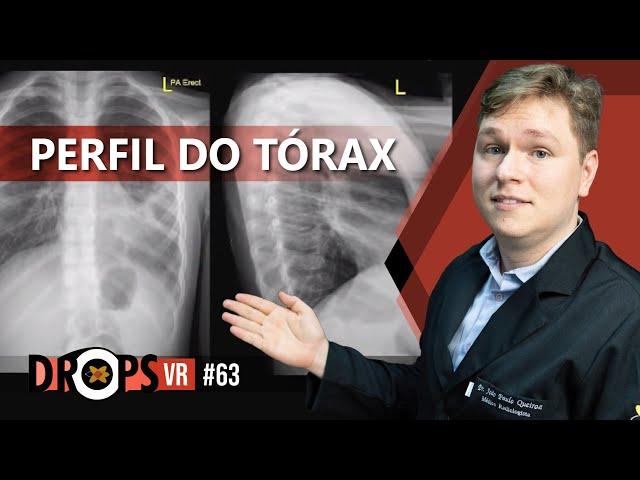 A IMPORTÂNCIA DO PERFIL NA RADIOGRAFIA DO TÓRAX