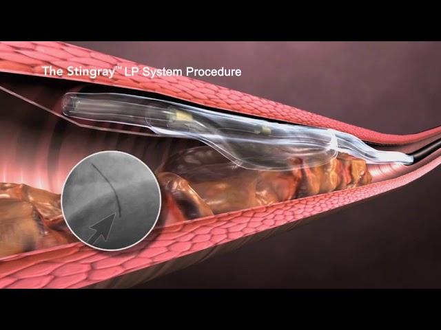 Boston Scientific Coronary CTO System Overview