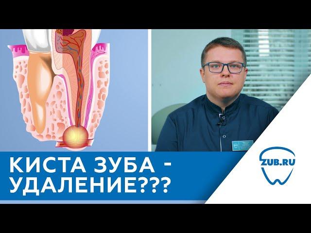 Киста зуба лечить или удалять