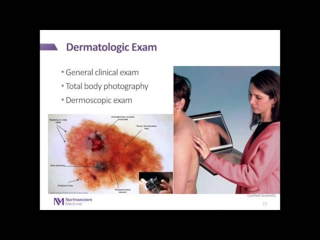 Melanoma: Introduction to Evolution, Diagnosis, & Treatment