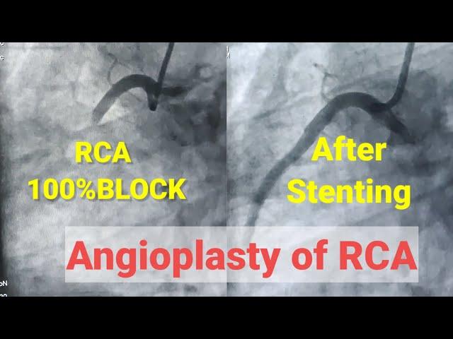 Primary Angioplasty of RCA, Stenting of RCA, 100% blcoked RCA