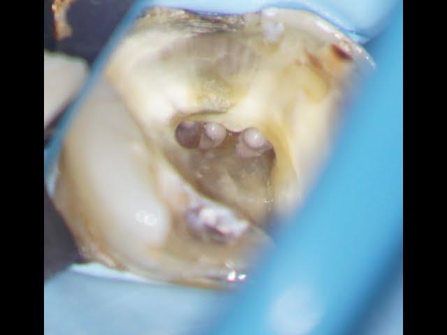 Molar root canal treatment. Overcoming hurdles during treatment of a five-canal LR6.