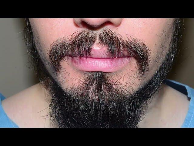 Beard hair transplants - achieving natural appearing results