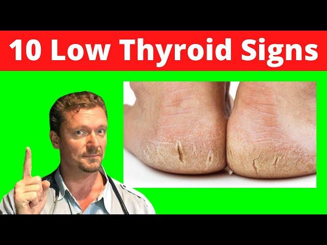 10 Skin Signs of LOW THYROID (Skin Signs of Hypothyroidism) 2024