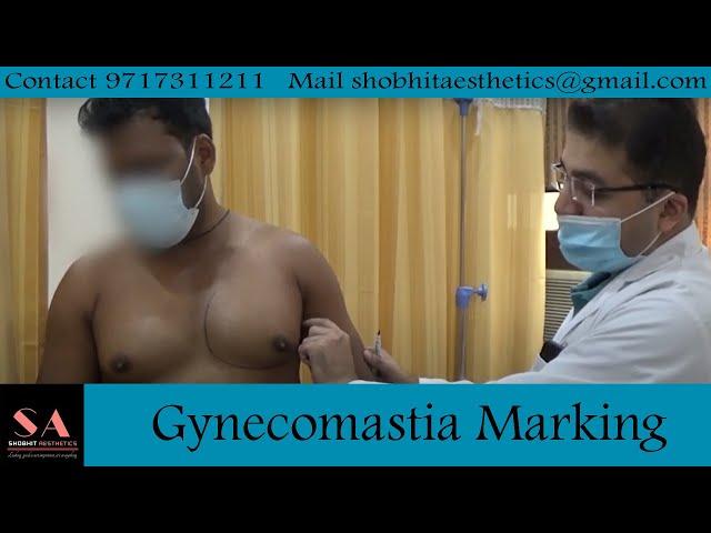 Gynecomastia Planning And Marking Before Surgery By Dr. Shobhit Gupta #gynecomastia #marking