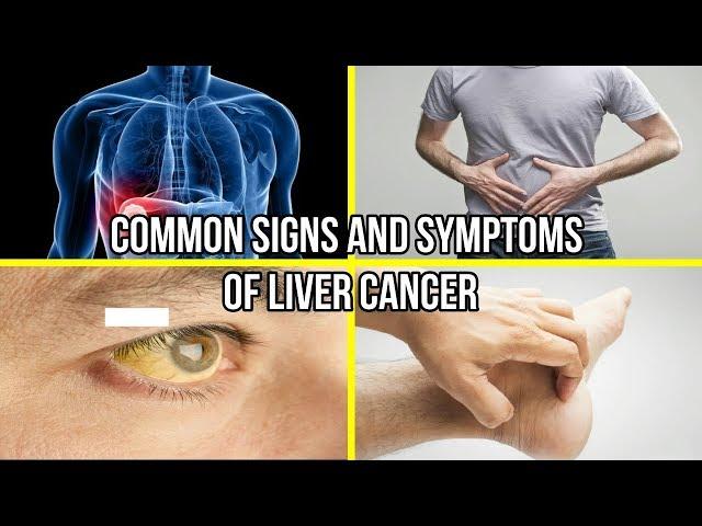 Common Signs and Symptoms Of Liver Cancer