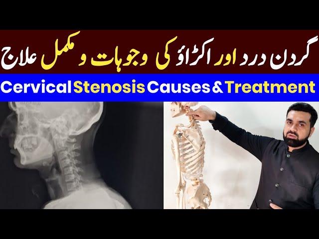 Neck Pain Treatment | Cervical Radiculopathy & Stenosis | Gardan Dard Ka Ilaj | Dr.Idrees | Dr.Noman