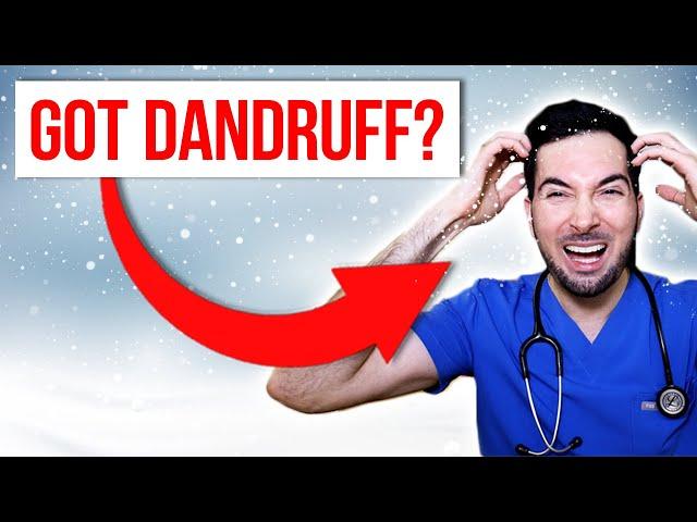 How to get rid of dandruff permanently at home and treatment
