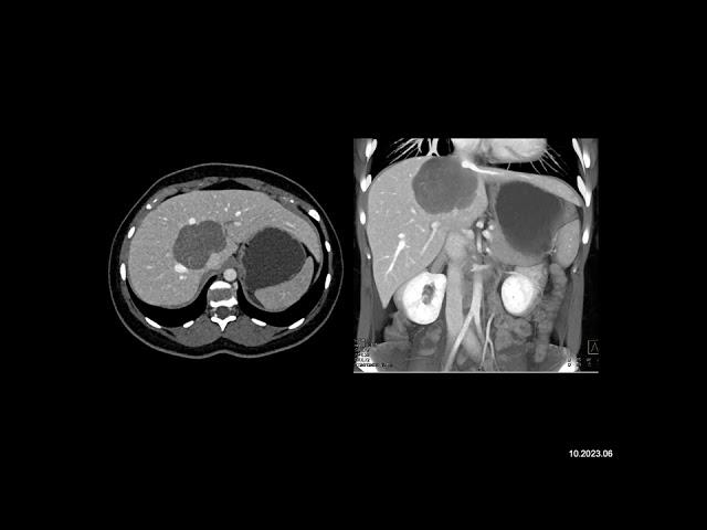 Radiology Case of the Week: In this 30ish year old female the most likely diagnosis is?