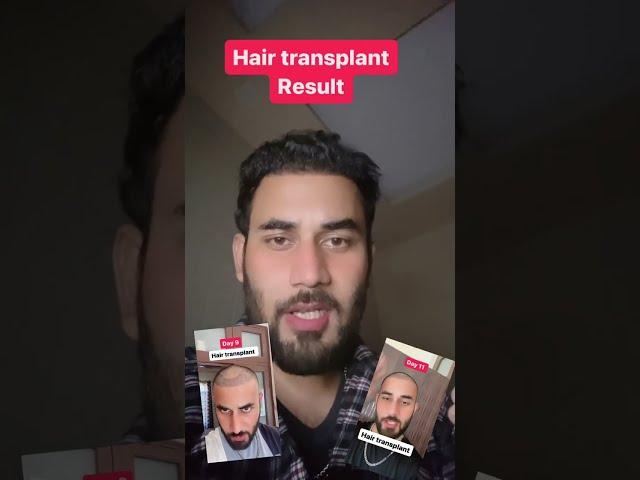 My hair transplant journey 4 months post #hairtransplant  ‍