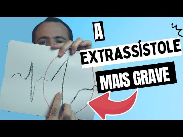 As extrassístoles podem ser gravíssimas sim, basta ter estas caracteristicas