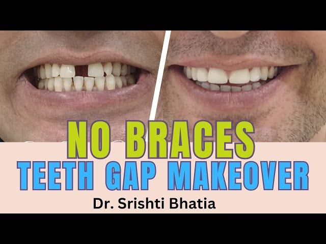 NO BRACES Teeth Gap Makeover; Dr. Srishti Bhatia #smilemakeover