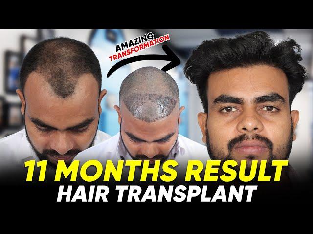 Hair Transplant in India | Best Results & Cost of Hair Transplant in India