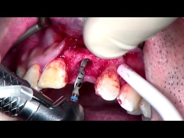 Step by Step Anterior Implant placement with GBR (with voiceover)