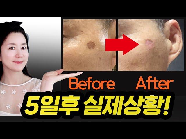 피부과 가려다집에서 확 다 뽑아버린 실제사례!! 검버섯, 비립종, 잡티제거 OO클렌저!