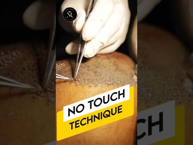 No Roots Touch Technique Hair Transplant | #hairtransplantation