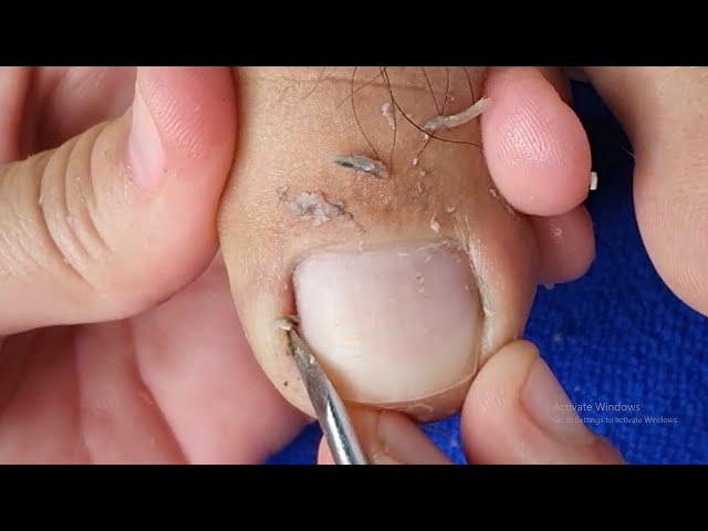 PEDICURE OF A MALE TOENAILS TUTORIAL | REMOVING INGROWN IN TOENAILS | SATISFYING VIDEO