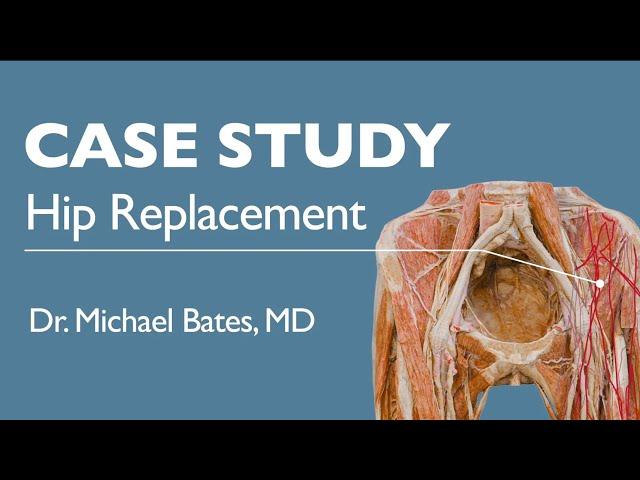 Hip Replacement Surgery Explained