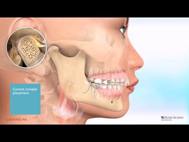 Carriere® Motion™ Appliance for Class II Patient Education Animation