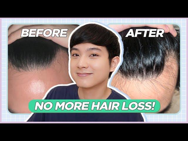 How I STOPPED My RECEDING HAIRLINE: My Hair Loss Treatment Journey (Filipino) | Jan Angelo