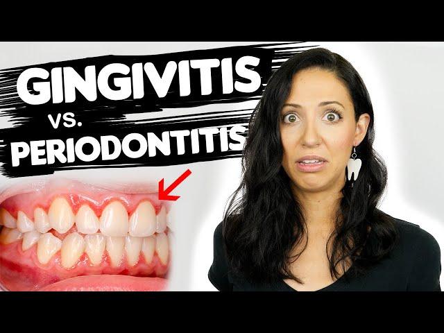 Do You Have Gingivitis or Periodontitis? | Different Stages Of Gum Disease