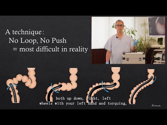 Colonoscopy Insertion Technique with Mikoto Model: How to avoid loops during colonoscopy?