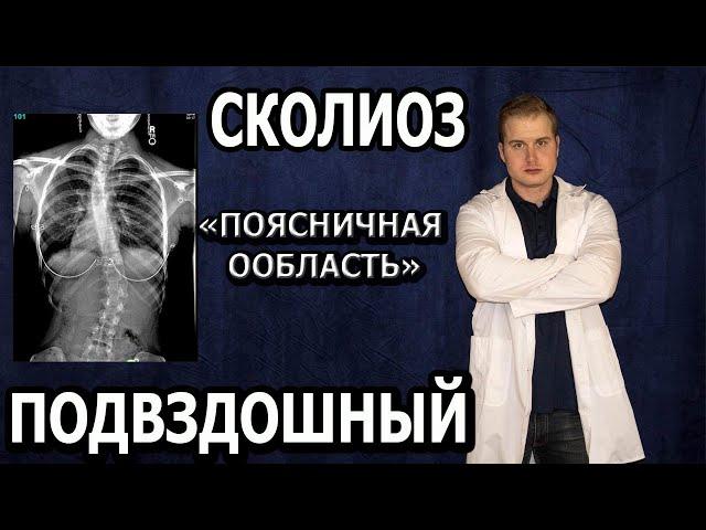 Подвздошный сколиоз или сколиоз поясничного отдела позвоночника, как лечить и чем опасен?!