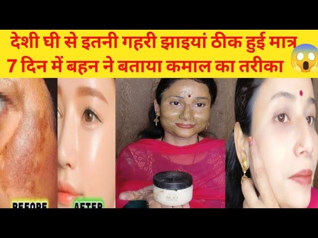 देशी घी से बने Facepack से किया कमाल झाइयां गई 100% Reduce Melasma,Pigmentation Discolouration