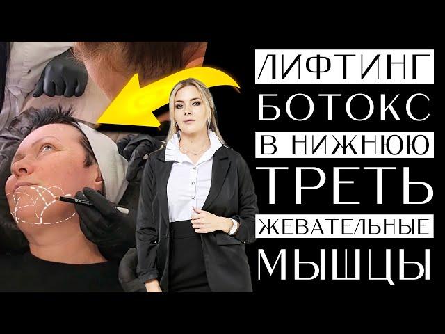 Лифтинг ботокс в нижнюю треть - жевательные мышцы