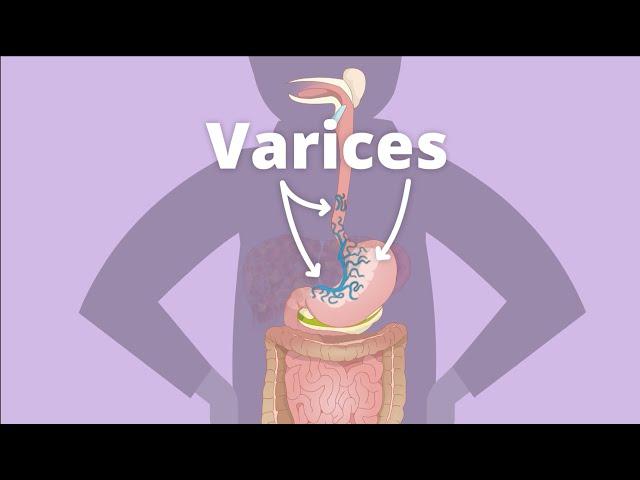 Cirrhosis – Varices