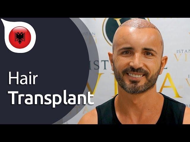 My Experience with Istanbul Vita from Albania | Hair Transplant in Istanbul / Turkey