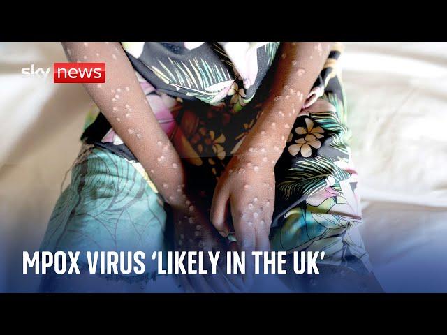 Experts warn deadly mpox virus is 'quite likely' in the UK