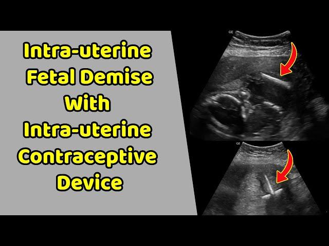 Intrauterine fetal demise with intrauterine contraceptive device