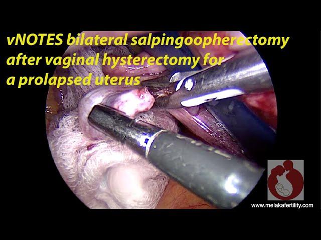 vNOTES bilateral SO after vag hyst for a prolapsed uterus