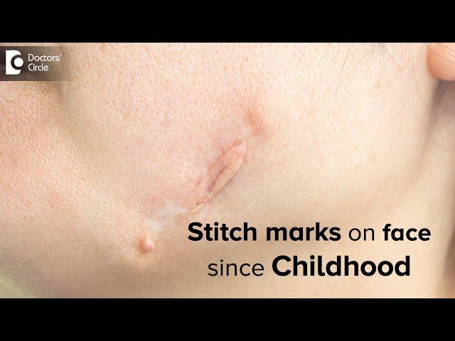 Stitch marks on face since Childhood. How to reduce this? - Dr. Rasya Dixit | Doctors' Circle