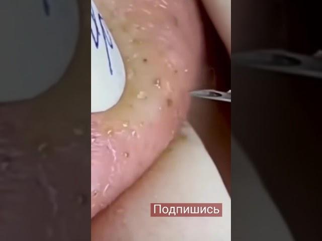 залипательное выдавливание жировиков с носа
