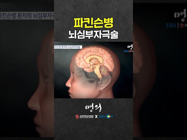 Parkinson's disease surgical treatment! deep brain stimulation