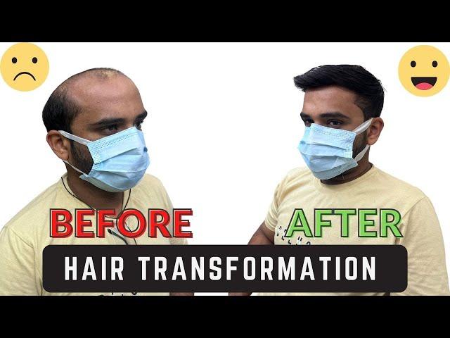 Bald patch on head | Original hair wig price | bald spot | Hair wig for men | Wig shops near me