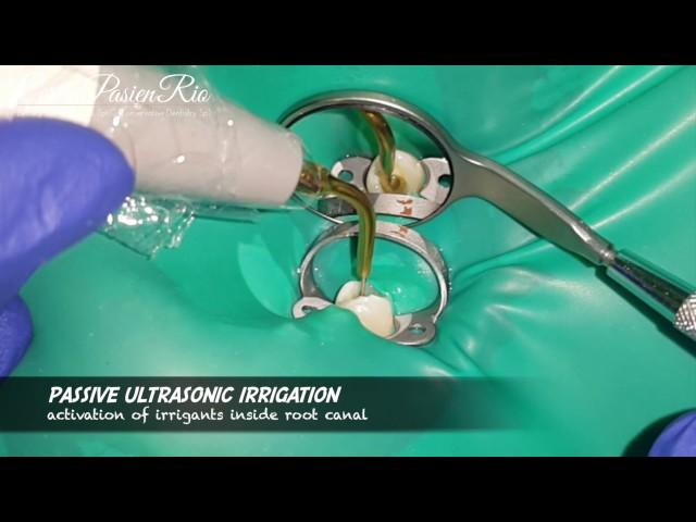 Restodontic treatment on mandibular premolar with gingivectomy (perawatan saluran akar gigi)