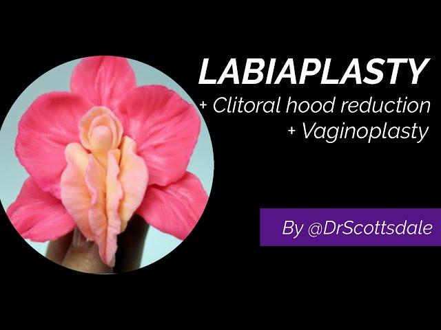 LABIAPLASTY + CLITORAL HOOD REDUCTION + VAGINOPLASTY by @DrScottsdale