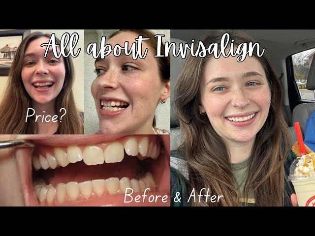 THINGS I WISH I KNEW BEFORE STARTING INVISALIGN | price, tips, before & after pics (Vlogmas Day 1)