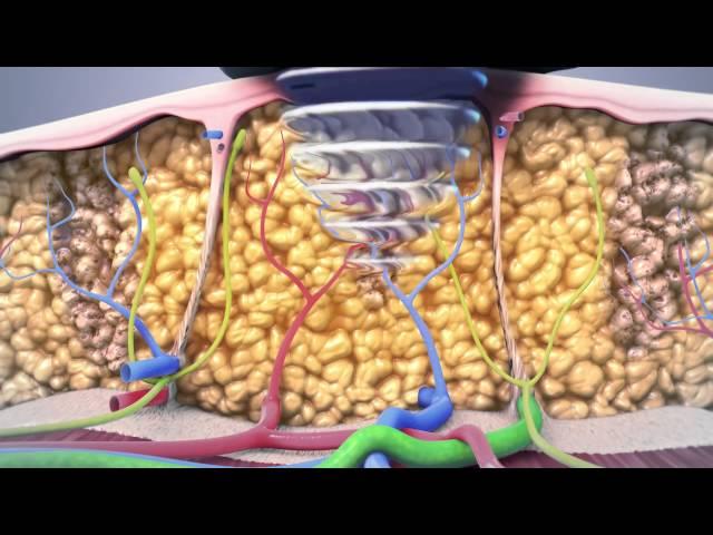 non surgical lipo animation