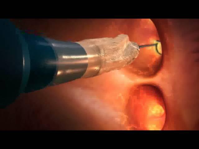 How Cryoballoon ablation works