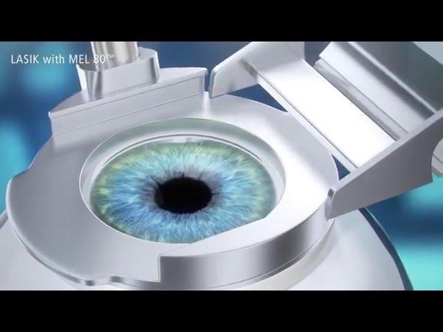 LASIK-Augenlaser OP-Behandlung (Mikrokeratom) in Wien-Zürich bei EyeLaser