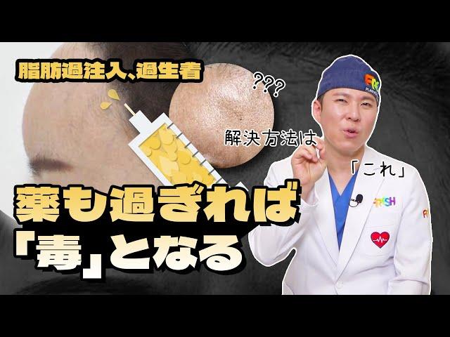 【顔脂肪吸引】 お顔に立体感を出したくて入れた脂肪が!!!!　不自然にならないように脂肪移植をするためには‍️？！　#韓国整形   #顔脂肪吸引 ＃童顔