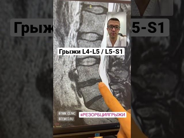 Резорбция двух грыж L4-L5 и L5-S1.