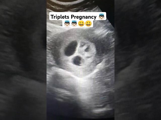 Triplet pregnancy seen in ultrasound #pregnancytimeline #triplets
