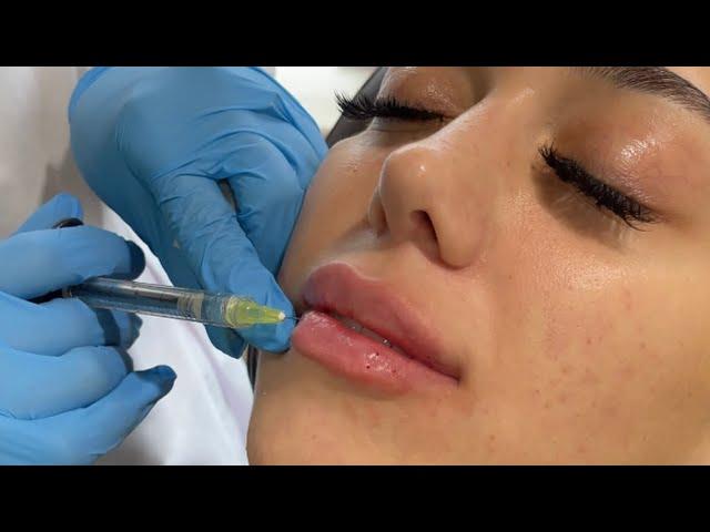 Lip injections - Natural and beautiful results