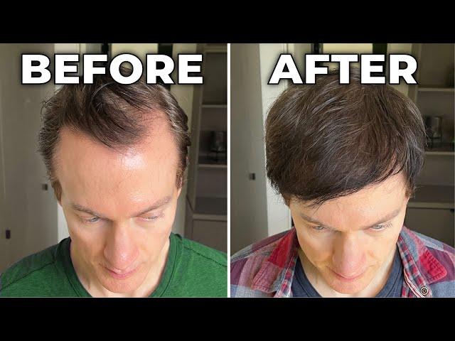 How I Reversed My Hair Loss + Greying